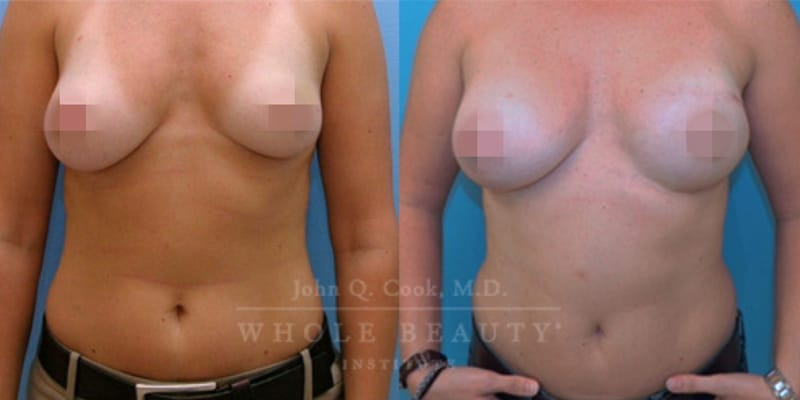 breast reconstruction | whole beauty institute