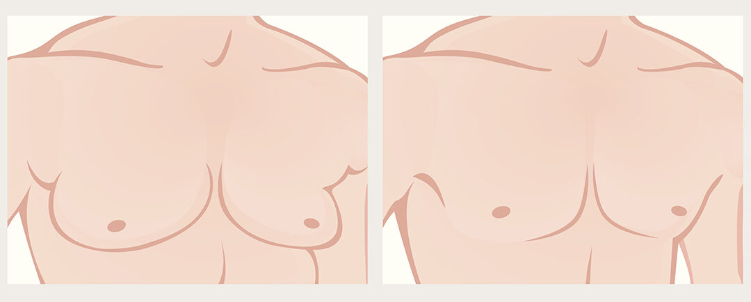 Gynecomastia - Male chest reduction