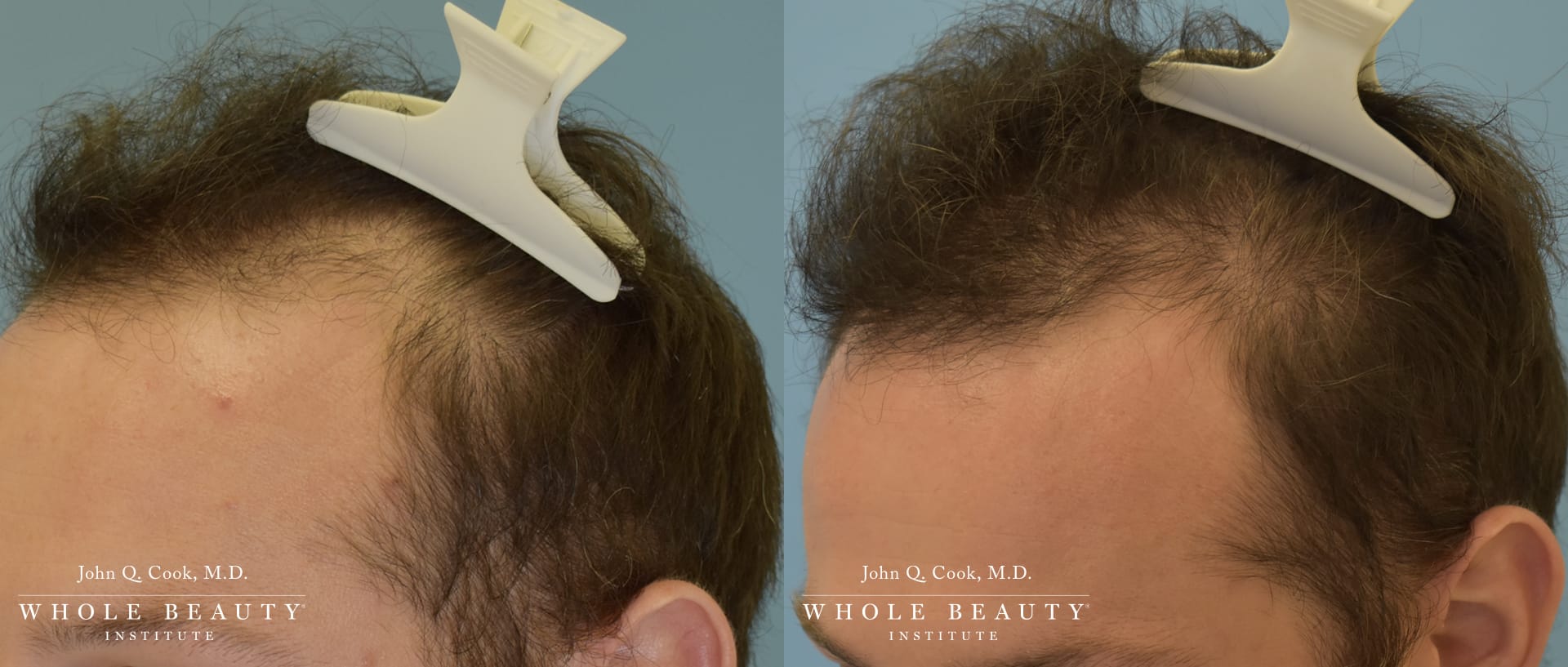 hair restoration for men