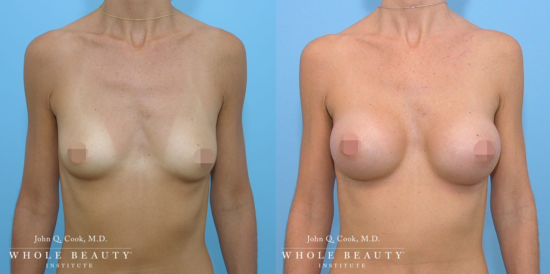 breast augmentation | Whole Beauty Institute