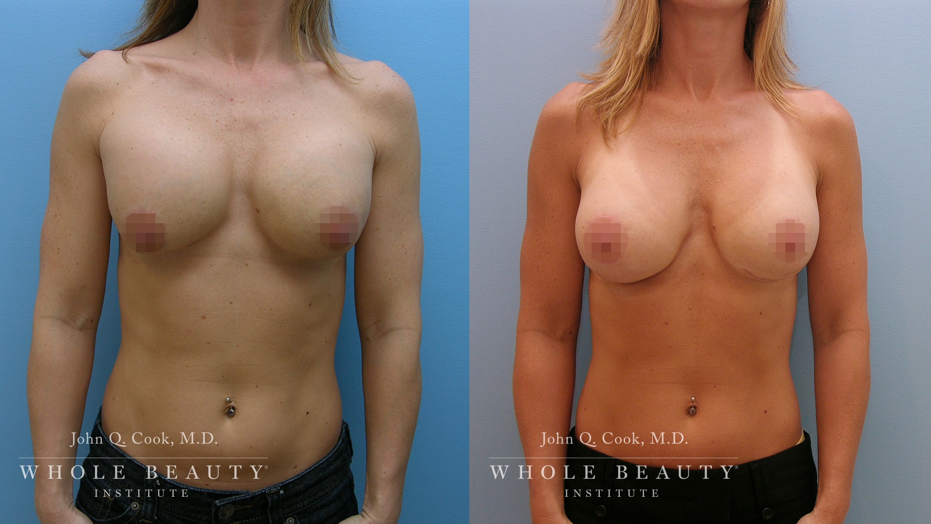 Breast Revision Surgery | Whole Beauty Institute