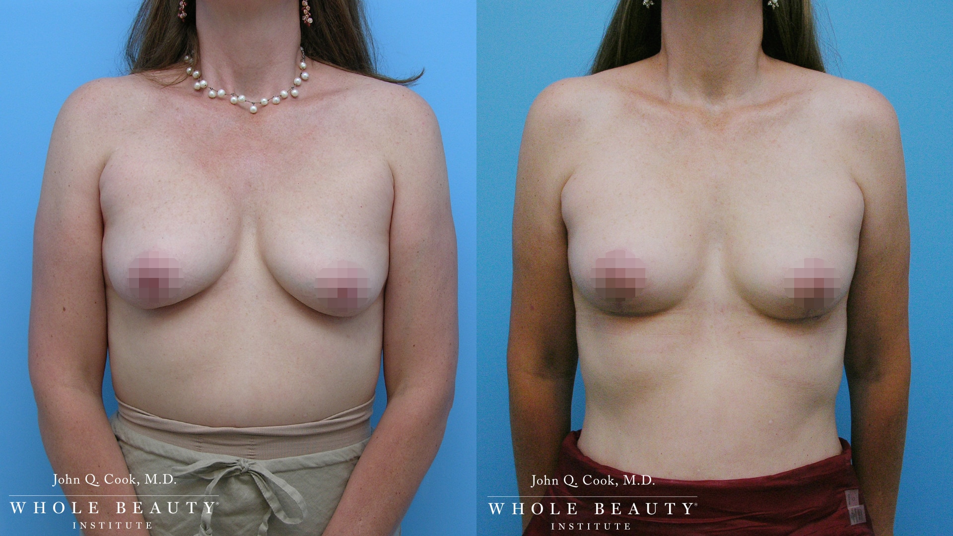 Breast Lift | Whole Beauty Institute