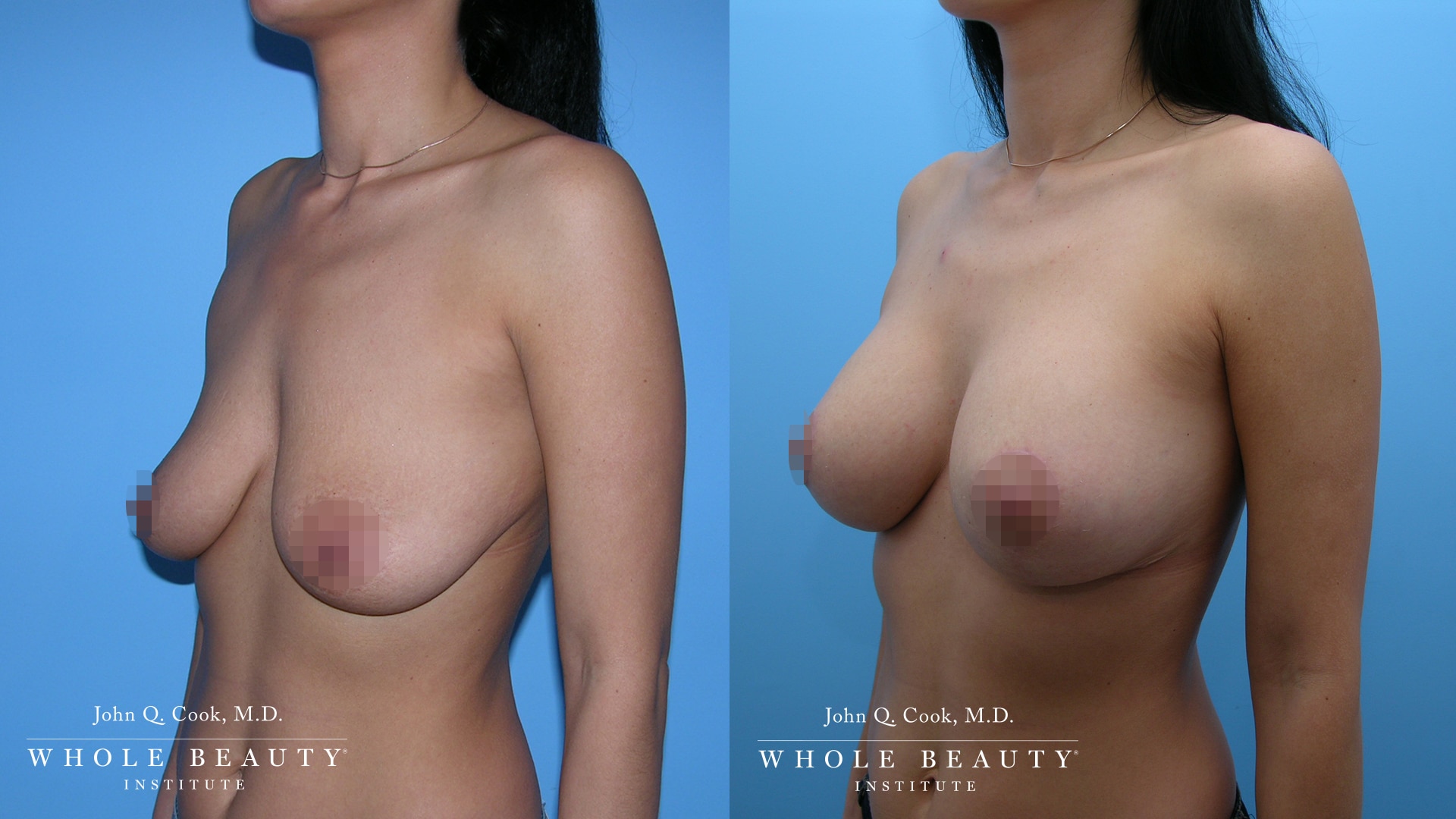 Augmentation with Lift breast augmentation  | Whole Beauty Institute