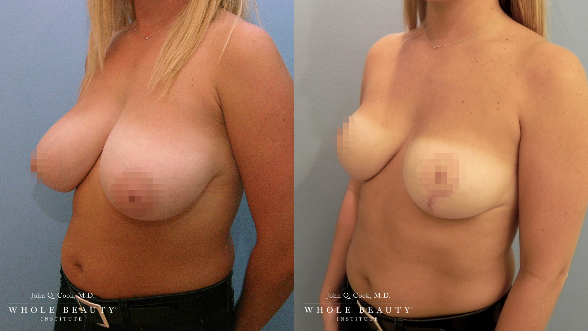 Breast Reduction | Whole Beauty Institute