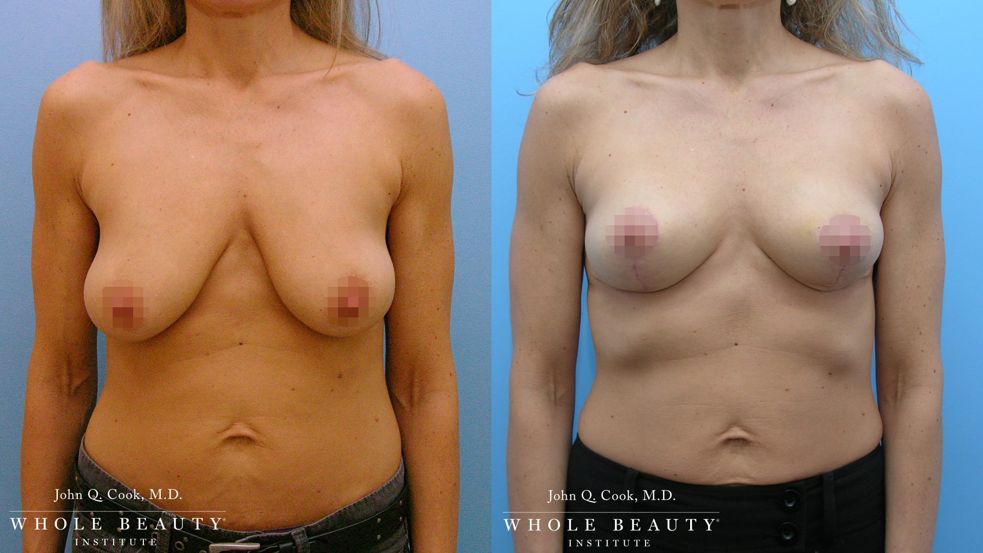 structural breast lift  | Whole Beauty Institute