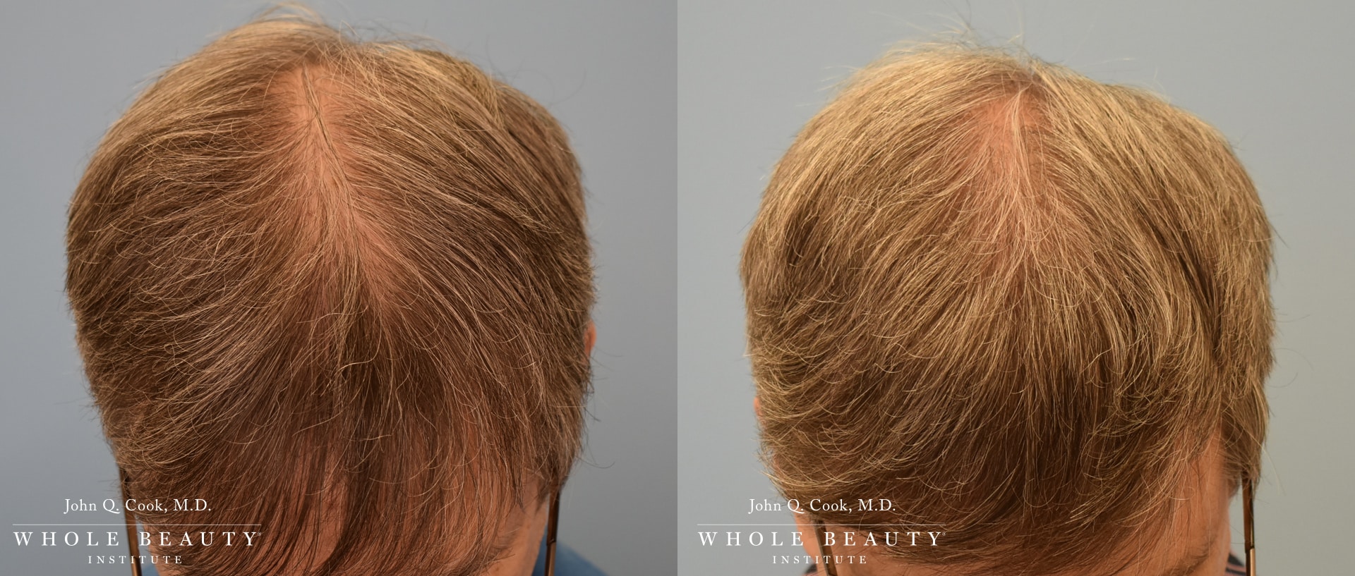 hair restoration before and after