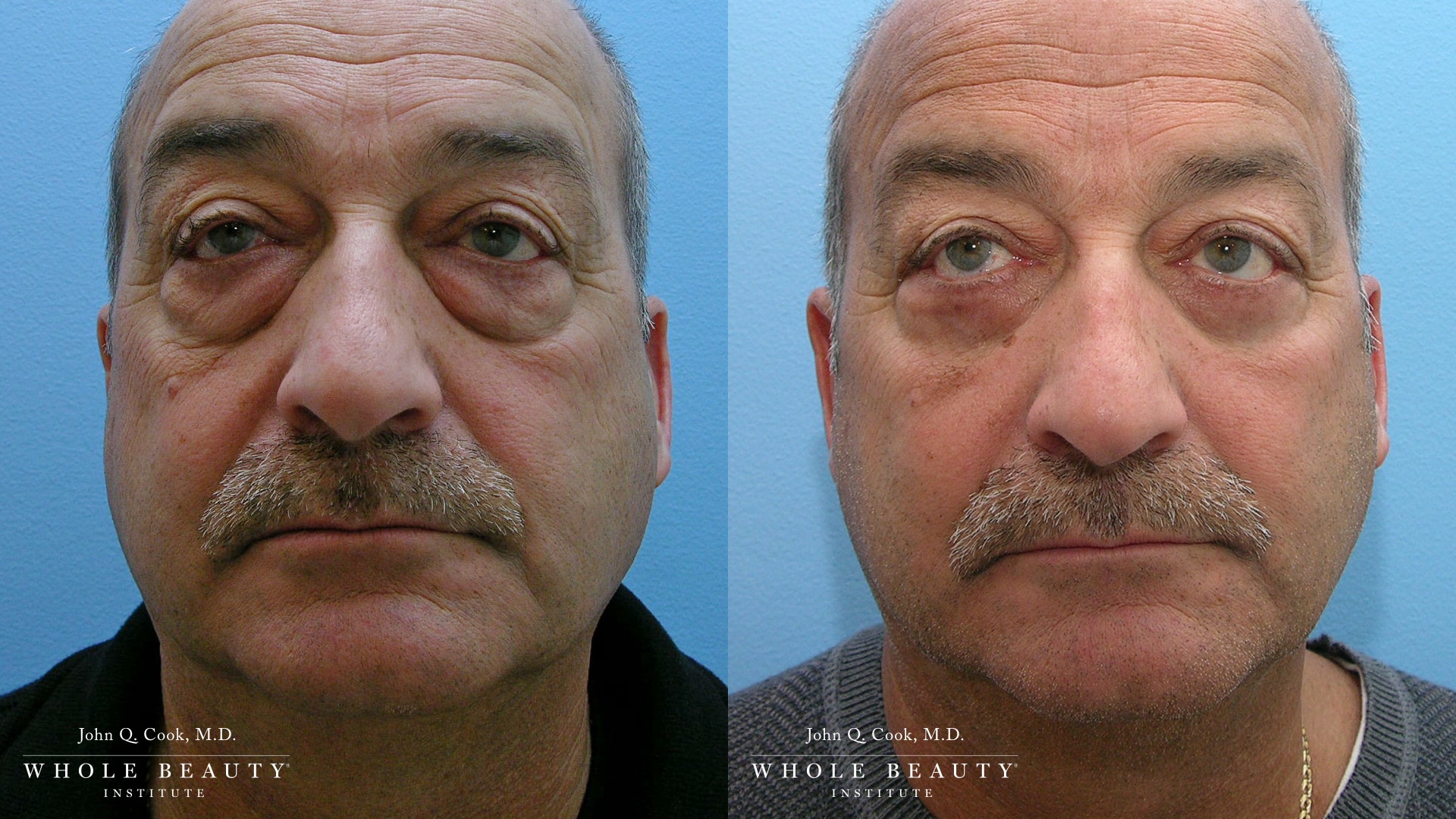 blepharoplasty before and after