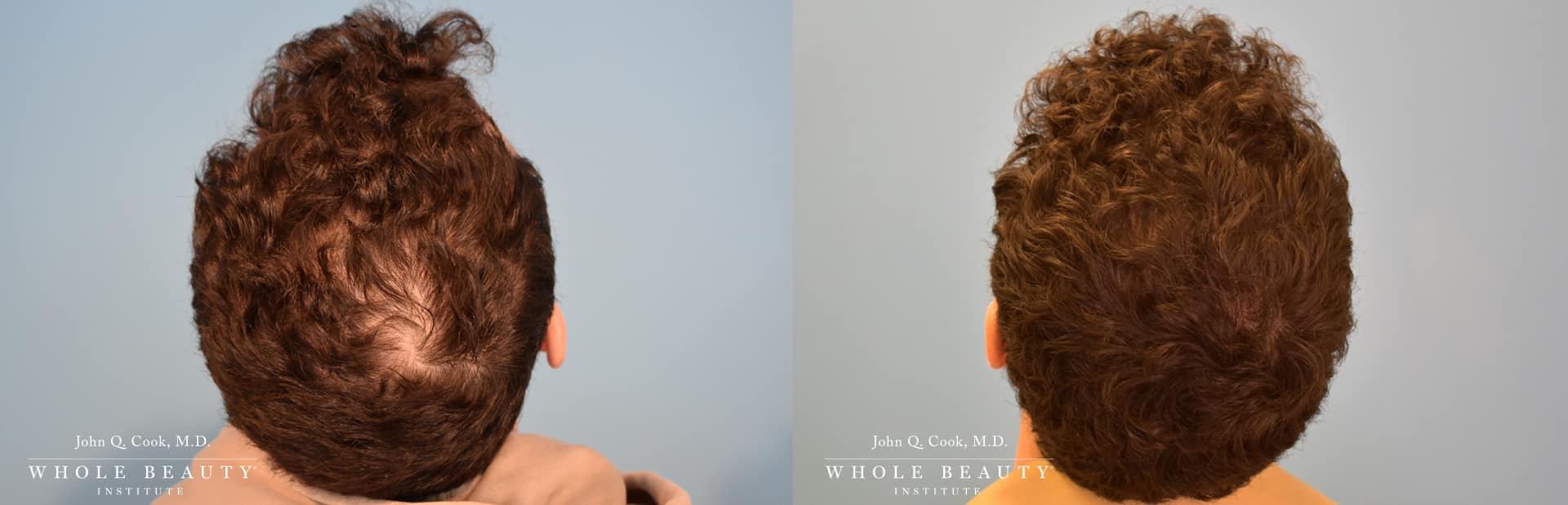 hair restoration for men