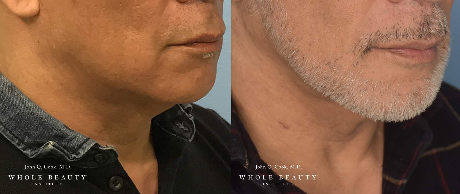 neck lift for men | whole beauty institute