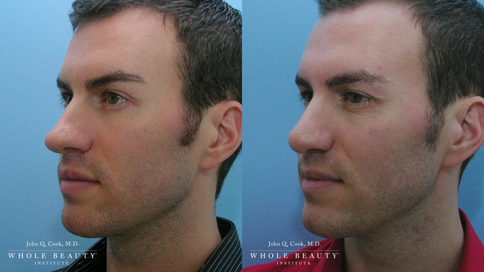 Rhinoplasty before and after