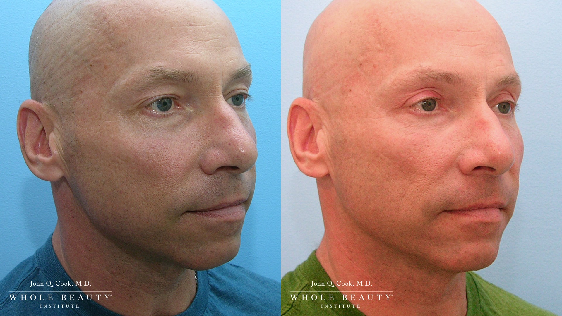 blepharoplasty before and after