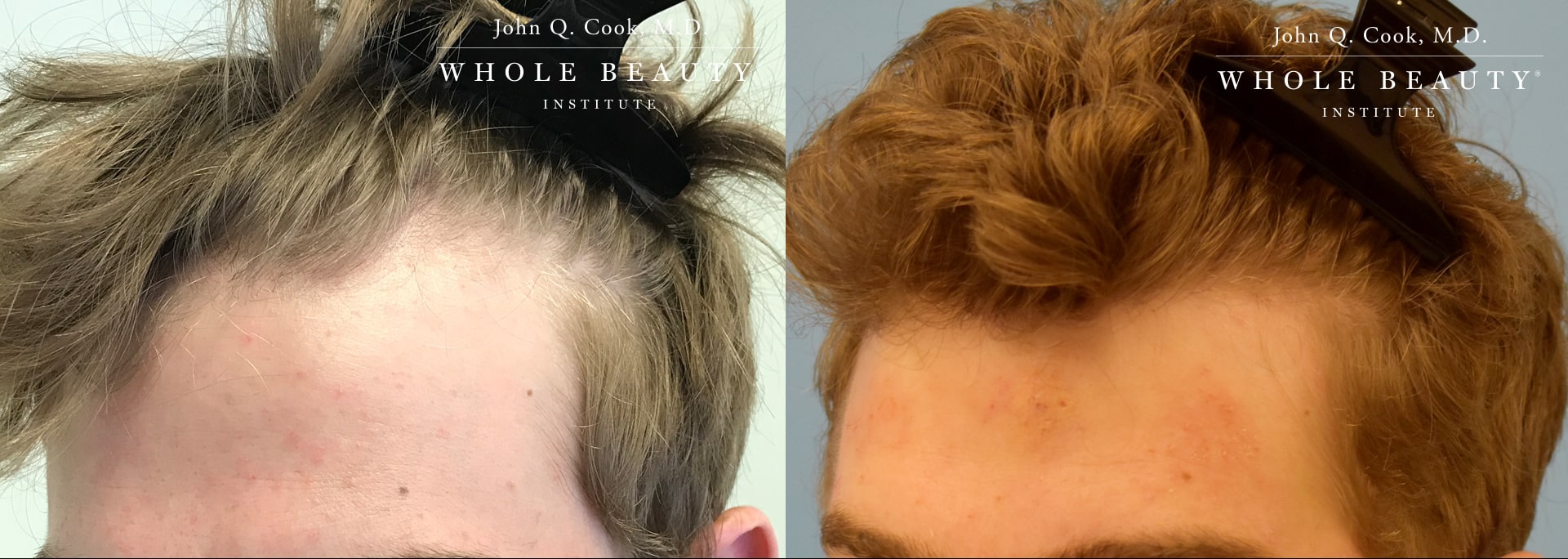 Male Hair Restoration Before and After